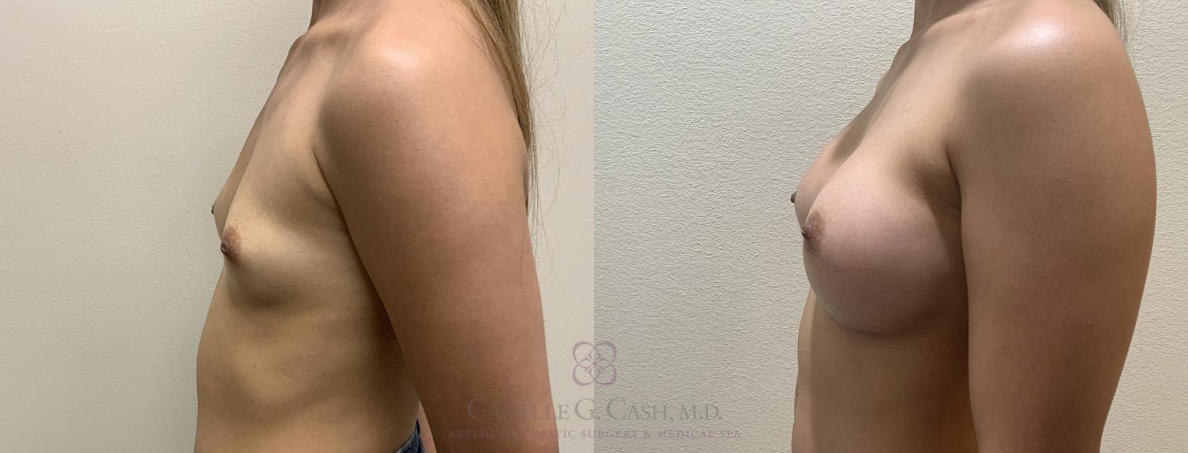 Before & After Breast Augmentation Case 390 View #6 View in Houston, TX