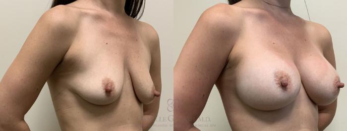 Before & After Breast Augmentation Case 392 View #2 View in Houston, TX