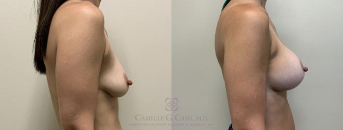 Before & After Breast Augmentation Case 392 View #4 View in Houston, TX