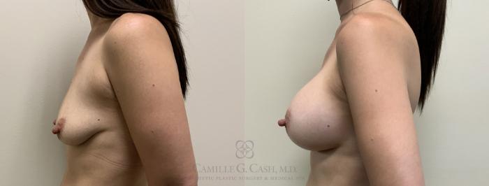 Before & After Breast Augmentation Case 392 View #5 View in Houston, TX