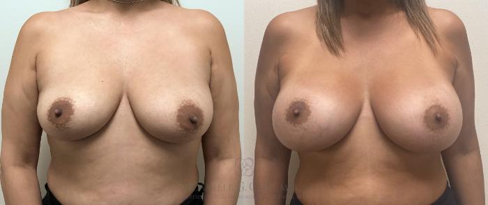 Before & After Breast Augmentation Case 406 Front View in Houston, TX