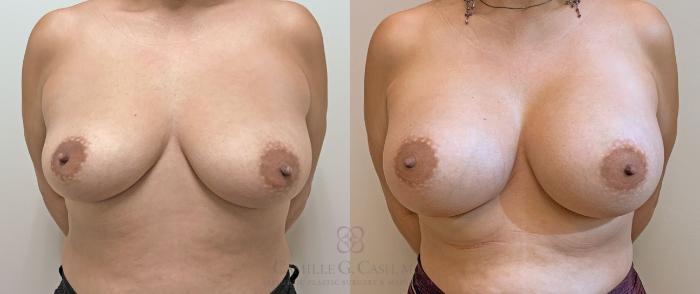 Before & After Breast Augmentation Case 406 View #1 View in Houston, TX