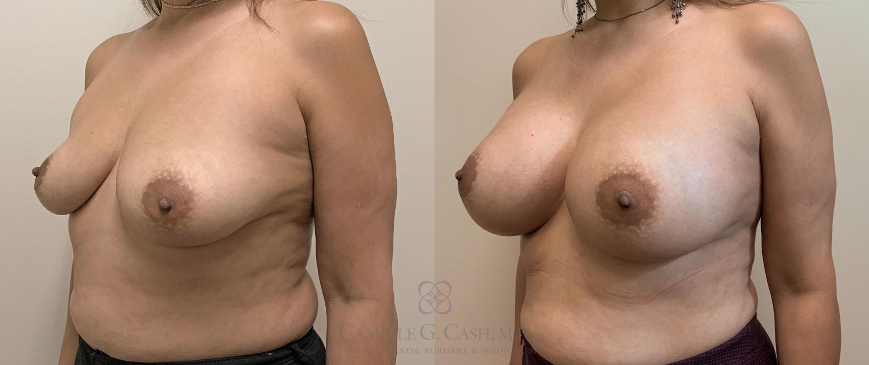 Before & After Breast Augmentation Case 406 View #2 View in Houston, TX