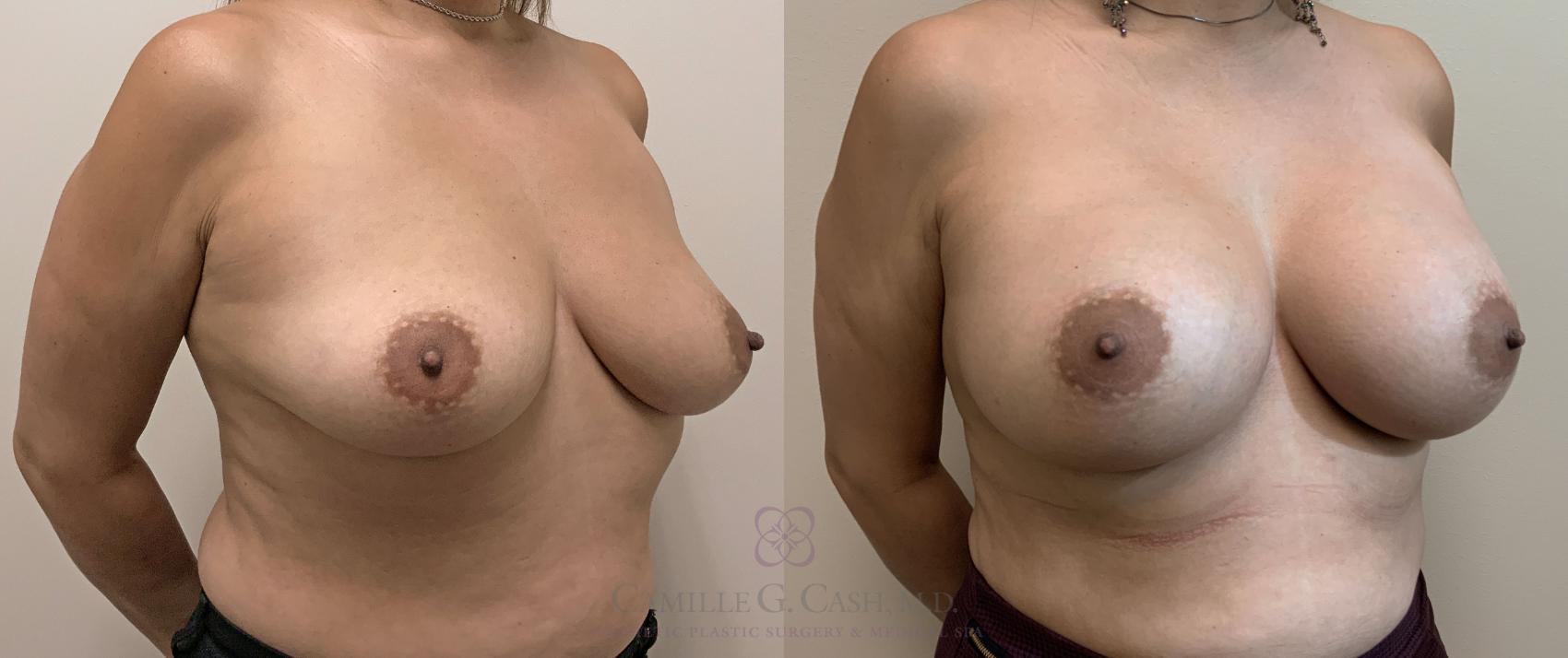 Before & After Breast Augmentation Case 406 View #3 View in Houston, TX