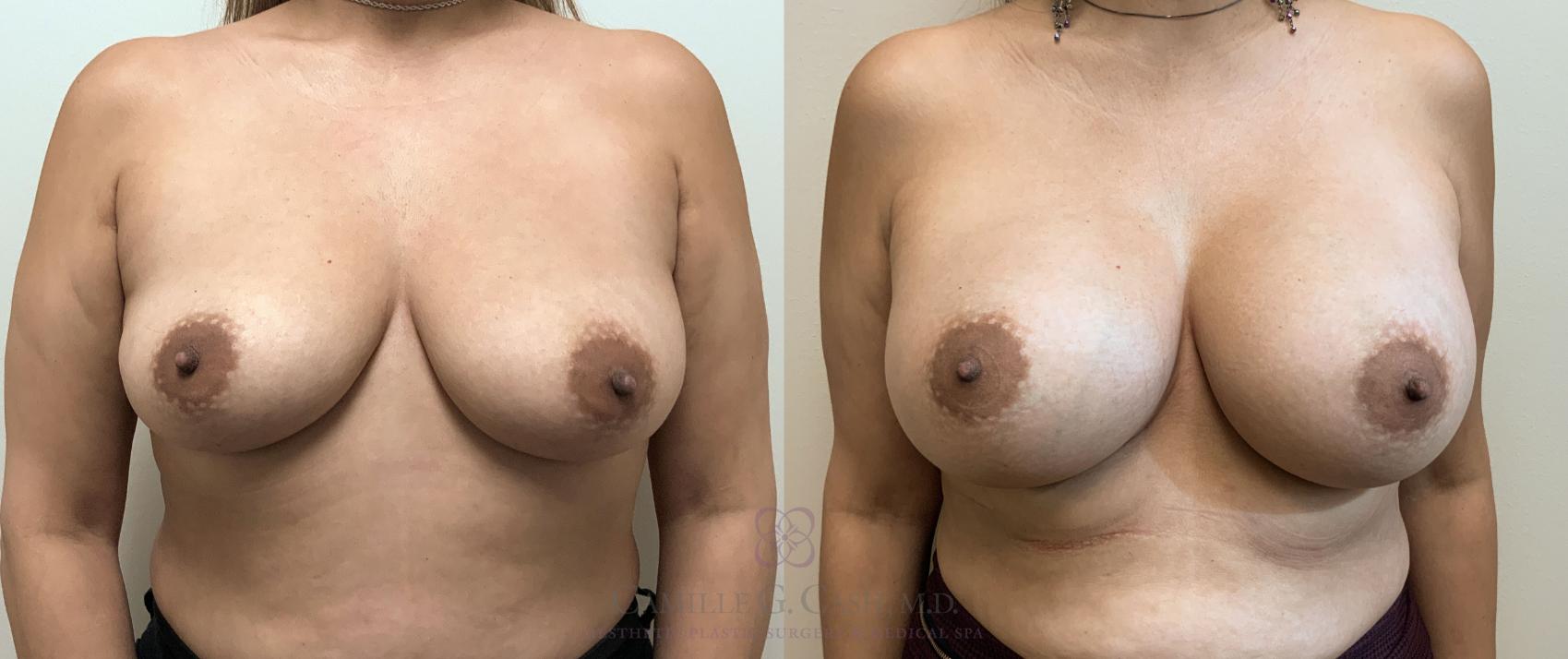 Before & After Breast Augmentation Case 406 View #4 View in Houston, TX