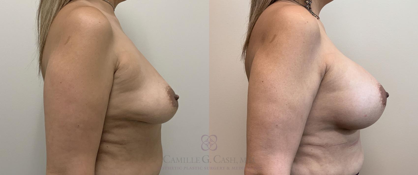 Before & After Breast Augmentation Case 406 View #5 View in Houston, TX