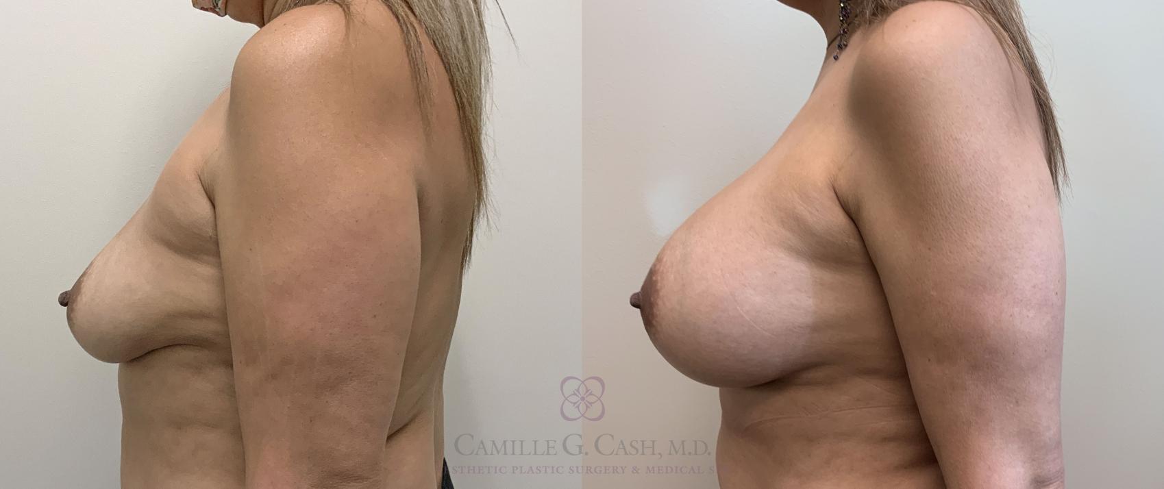 Before & After Breast Augmentation Case 406 View #6 View in Houston, TX