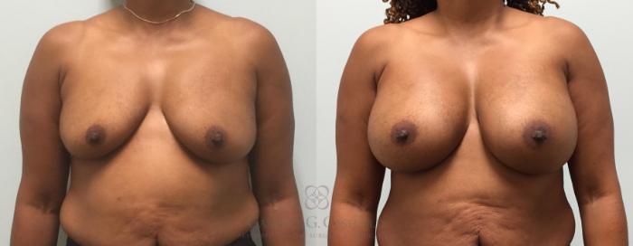 Before & After Breast Augmentation Case 436 View #1 View in Houston, TX