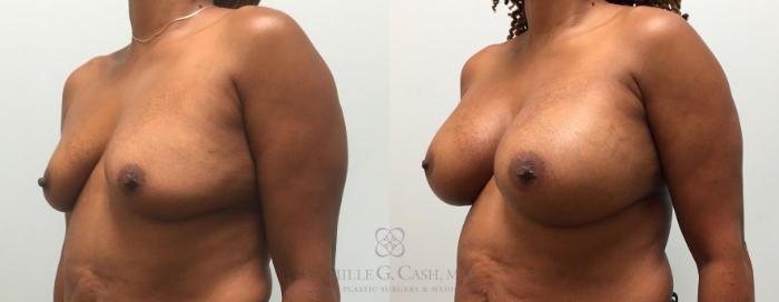 Before & After Breast Augmentation Case 436 View #2 View in Houston, TX