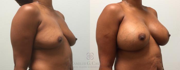 Before & After Breast Augmentation Case 436 View #3 View in Houston, TX