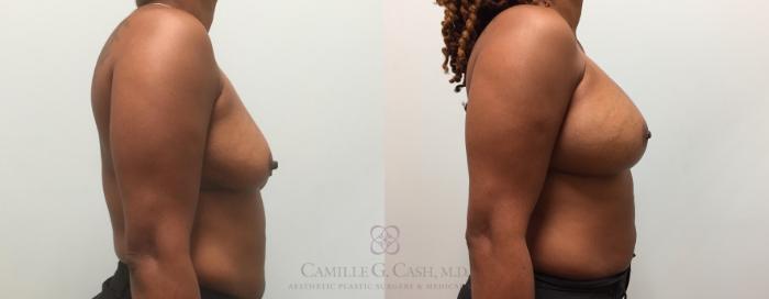 Before & After Breast Augmentation Case 436 View #4 View in Houston, TX
