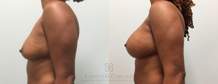 Before & After Breast Augmentation Case 436 View #5 View in Houston, TX