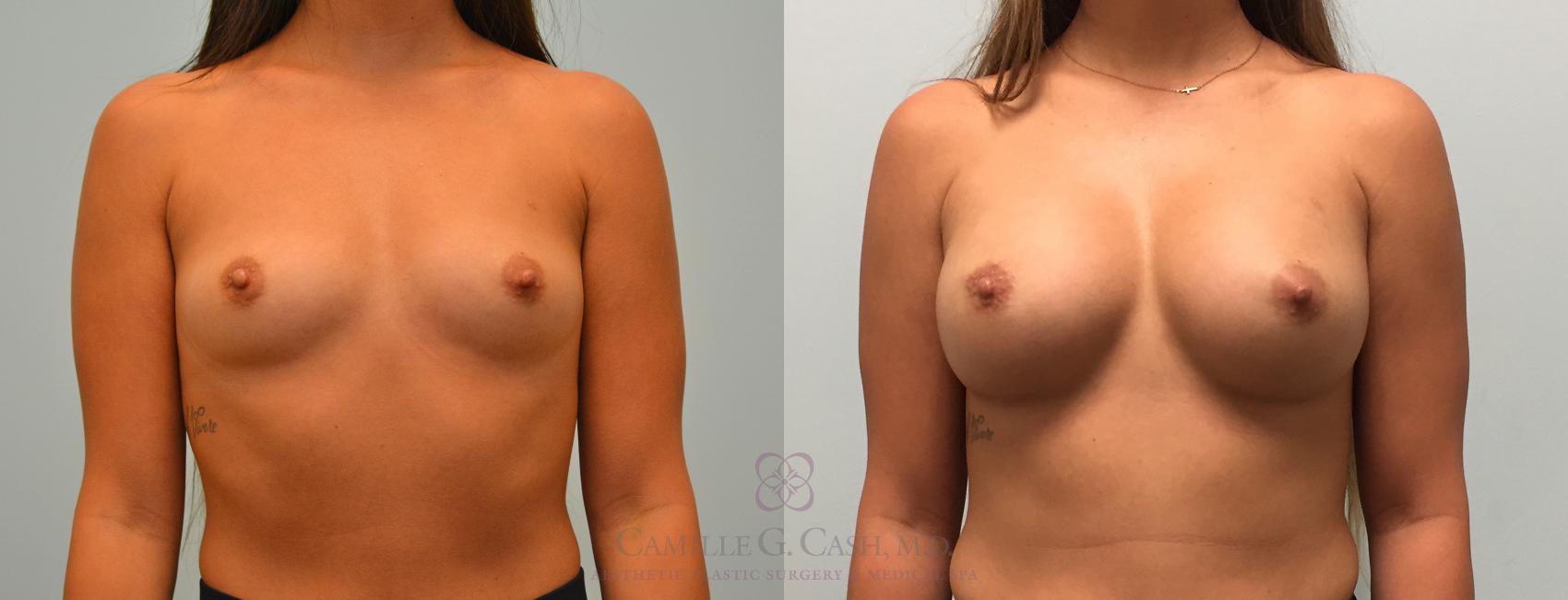 Before & After Breast Augmentation Case 445 View #1 View in Houston, TX