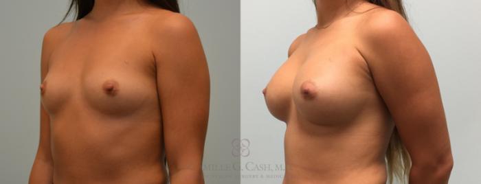 Before & After Breast Augmentation Case 445 View #2 View in Houston, TX