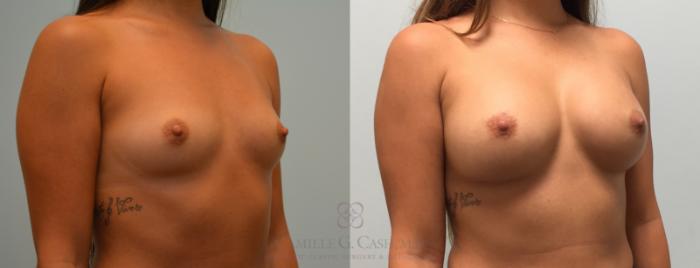 Before & After Breast Augmentation Case 445 View #3 View in Houston, TX