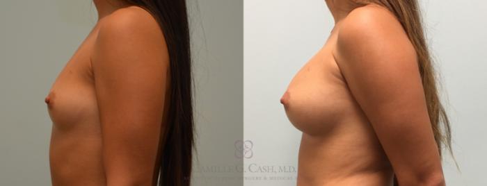 Before & After Breast Augmentation Case 445 View #4 View in Houston, TX
