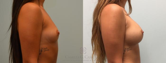 Before & After Breast Augmentation Case 445 View #5 View in Houston, TX