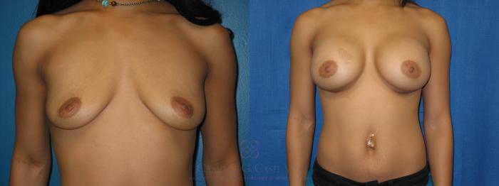 Before & After Breast Augmentation Case 45 View #1 View in Houston, TX