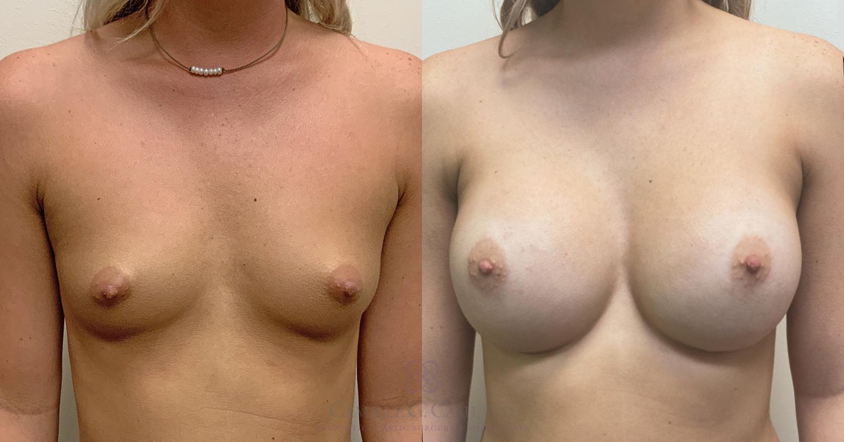 Before & After Breast Augmentation Case 453 Front View in Houston, TX