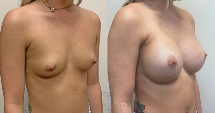 Before & After Breast Augmentation Case 453 Left Oblique View in Houston, TX