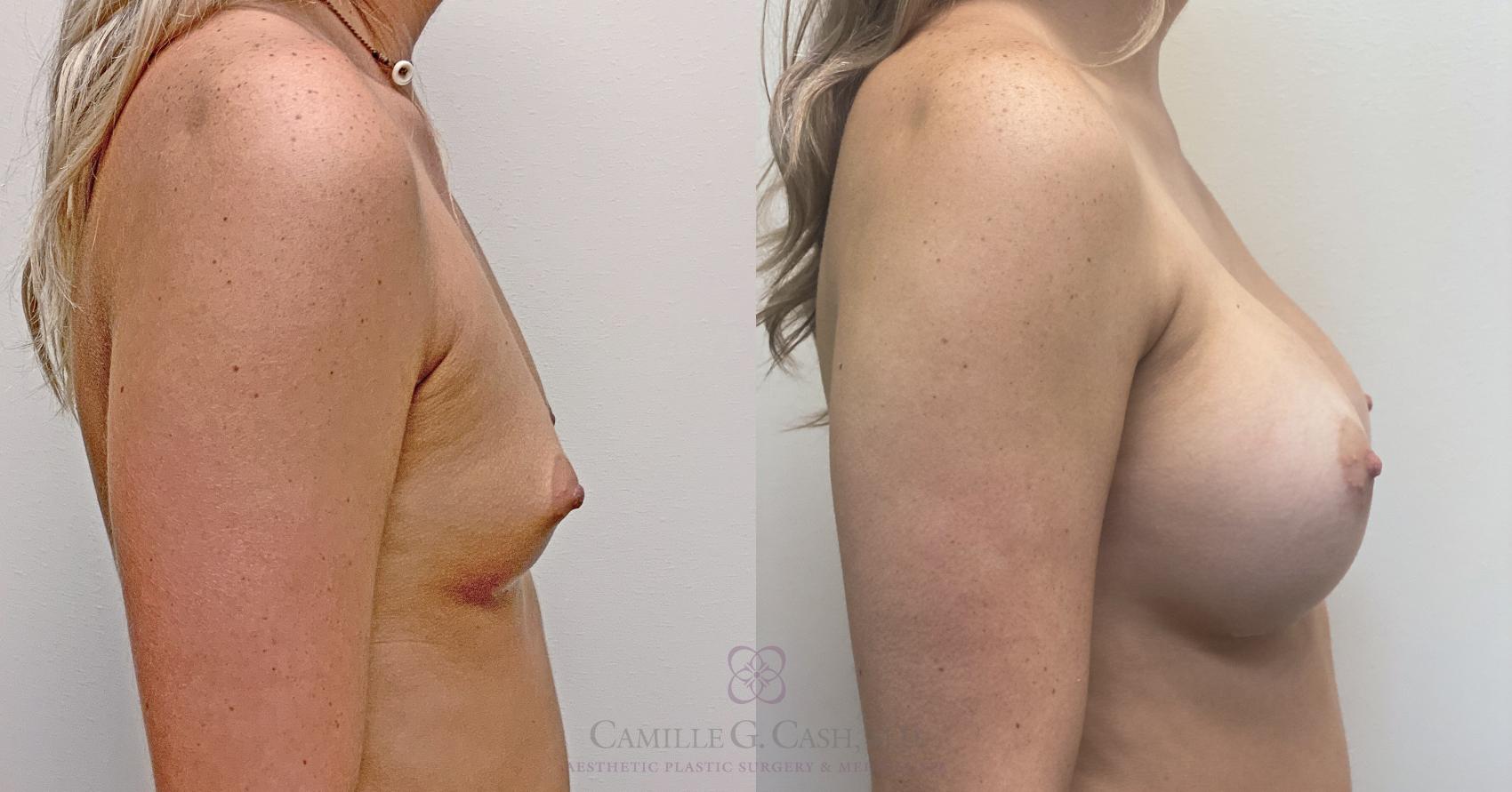 Before & After Breast Augmentation Case 453 Left Side View in Houston, TX