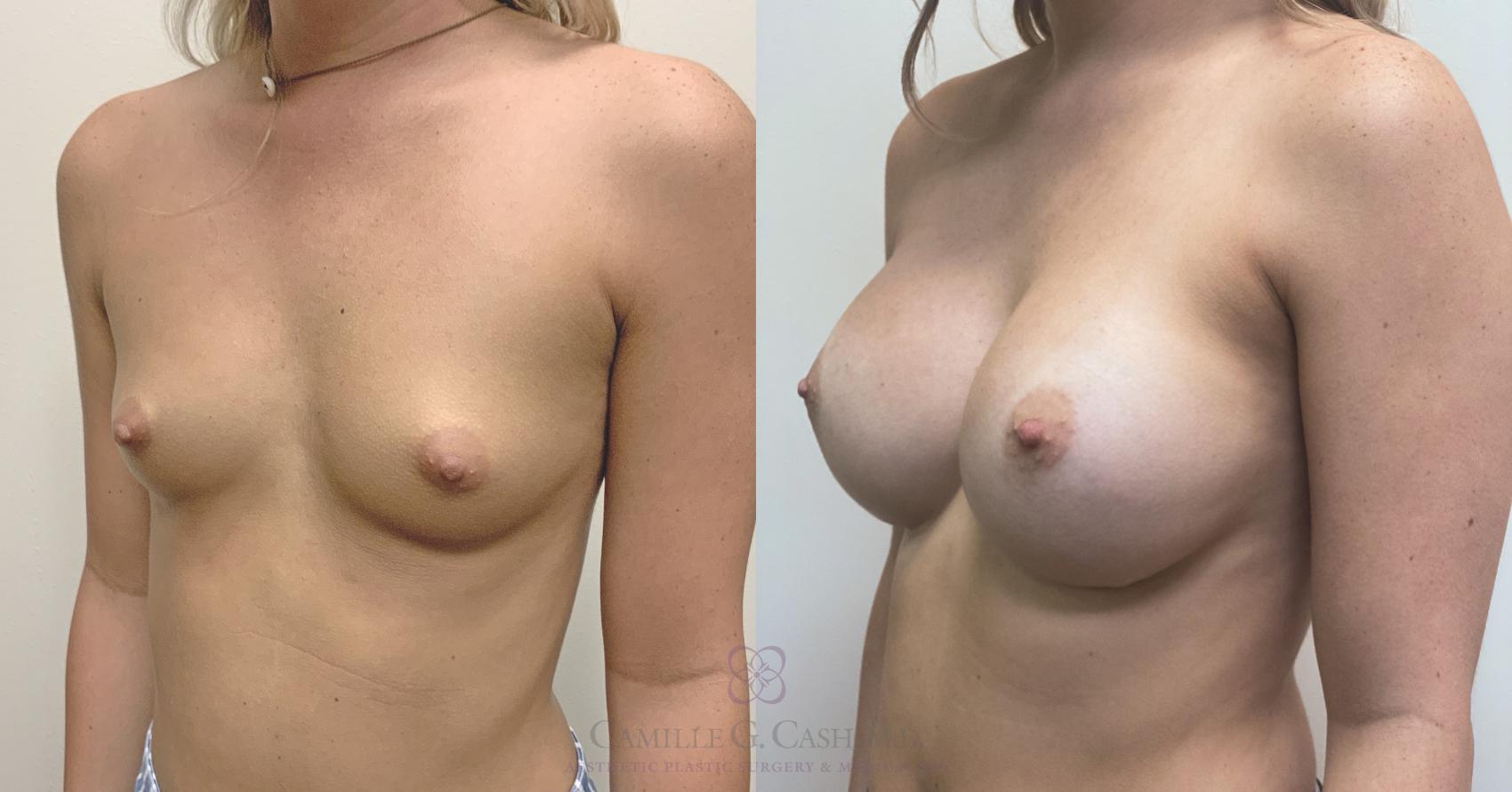 Before & After Breast Augmentation Case 453 Right Oblique View in Houston, TX