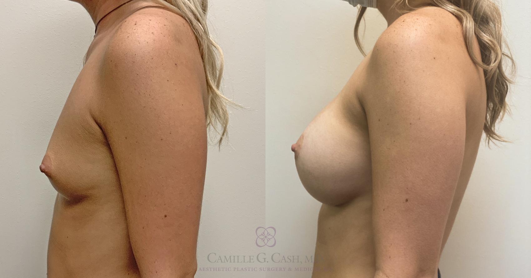 Before & After Breast Augmentation Case 453 Right Side View in Houston, TX