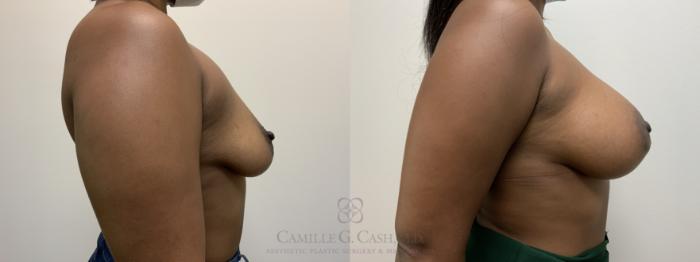 Before & After Breast Augmentation Case 456 Left Side View in Houston, TX