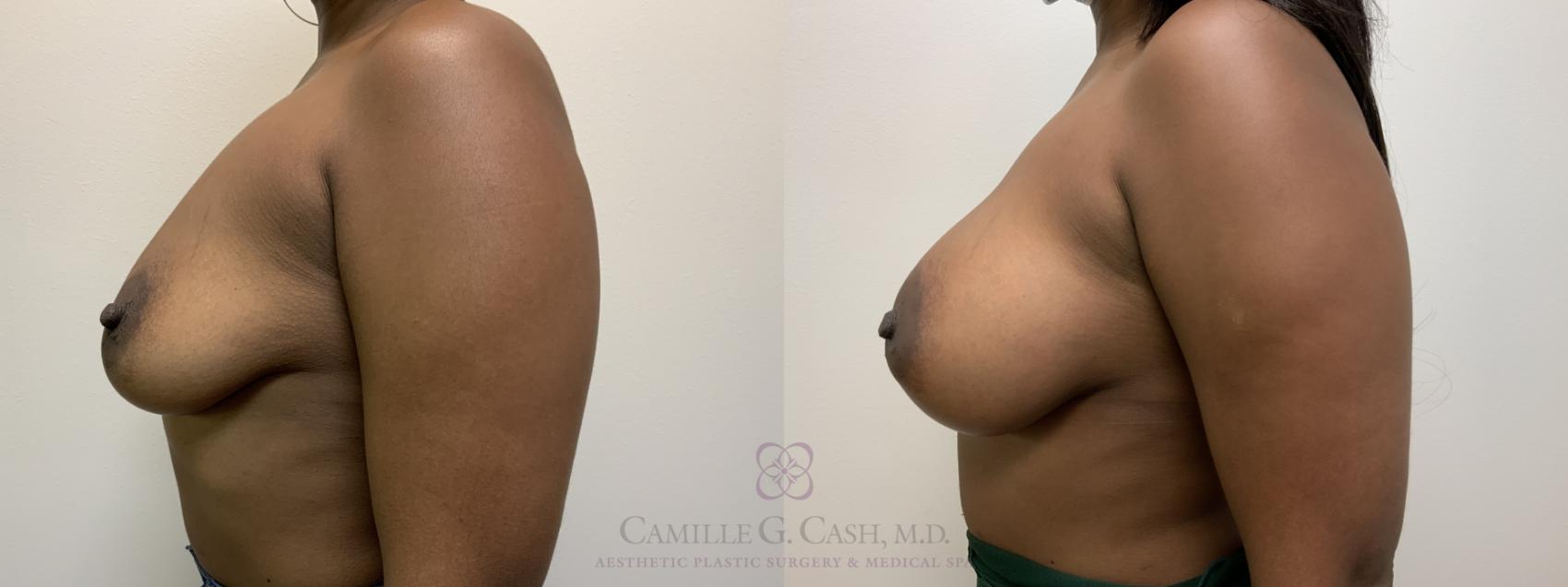 Before & After Breast Augmentation Case 456 Right Side View in Houston, TX