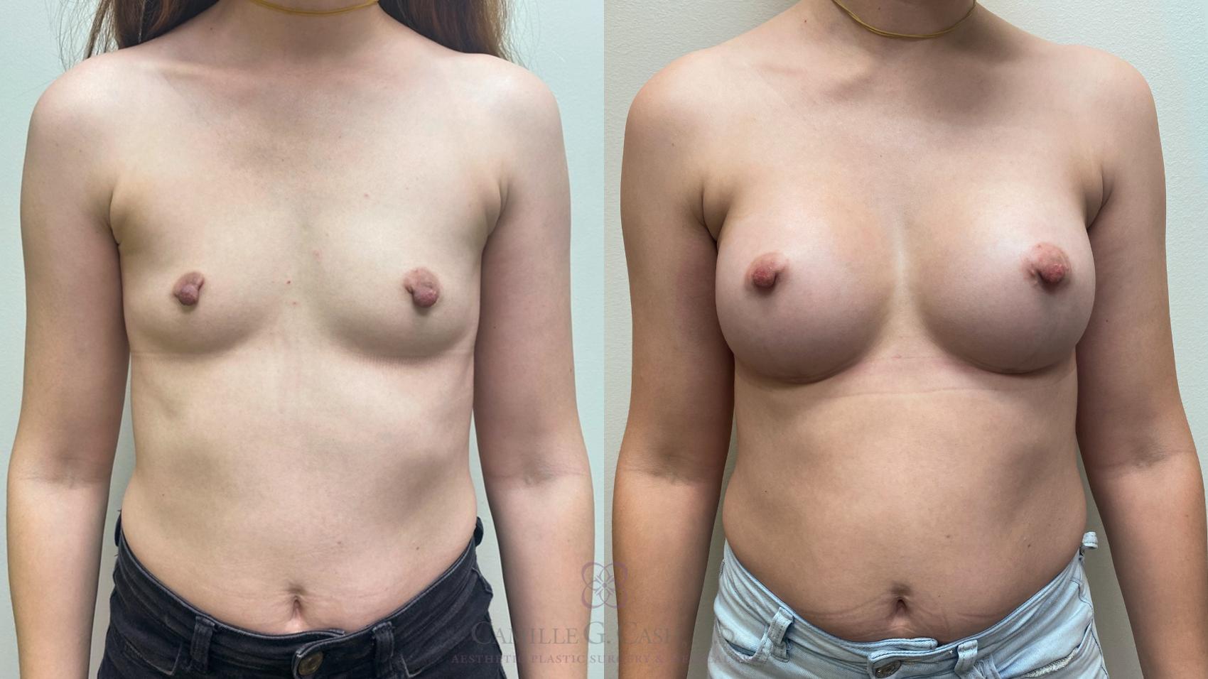 Before & After Breast Augmentation Case 457 5 View in Houston, TX