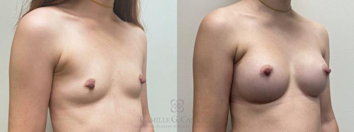Before & After Breast Augmentation Case 457 Left Oblique View in Houston, TX