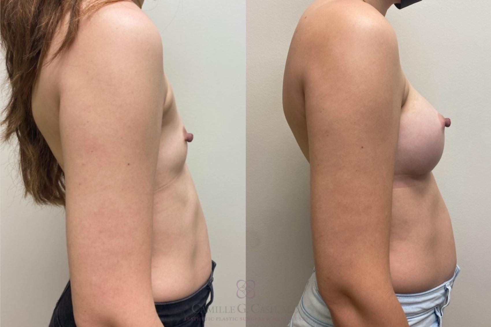 Before & After Breast Augmentation Case 457 Left Side View in Houston, TX