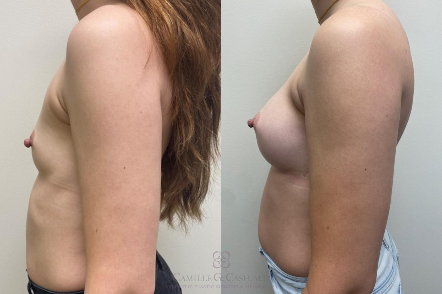 Before & After Breast Augmentation Case 457 Right Side View in Houston, TX