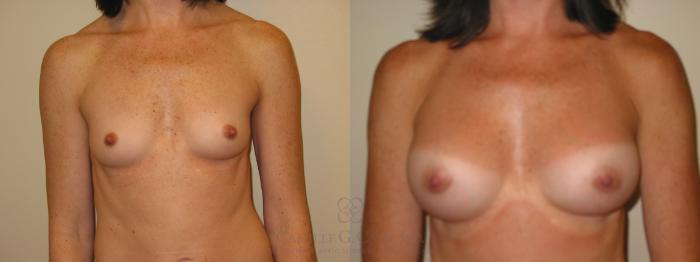 Before & After Breast Augmentation Case 46 View #2 View in Houston, TX