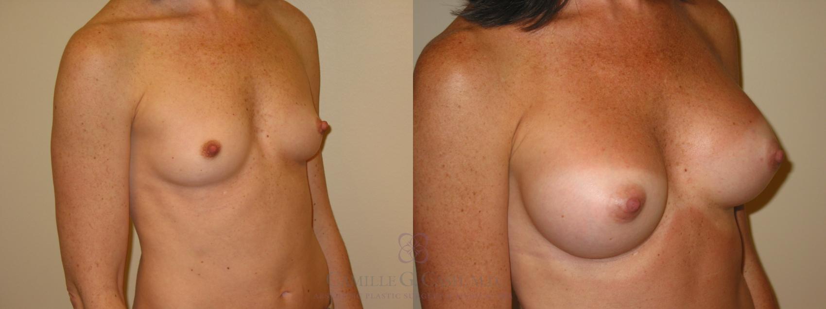 Before & After Breast Augmentation Case 46 View #3 View in Houston, TX
