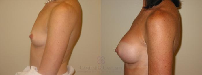 Before & After Breast Augmentation Case 46 View #4 View in Houston, TX