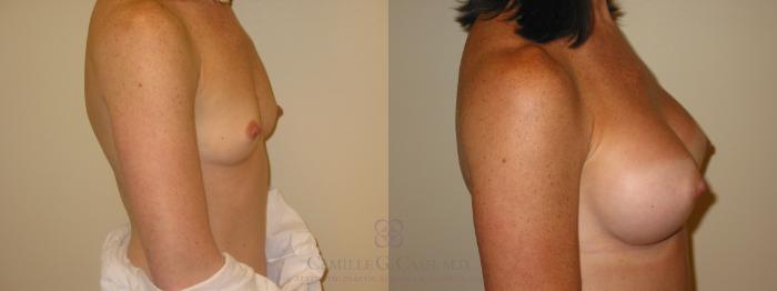 Before & After Breast Augmentation Case 46 View #5 View in Houston, TX
