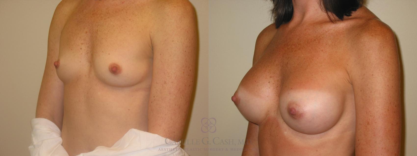 Before & After Breast Augmentation Case 46 View #6 View in Houston, TX