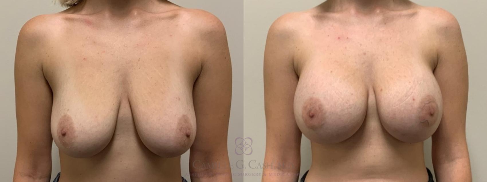 Before & After Breast Augmentation Case 460 Front View in Houston, TX