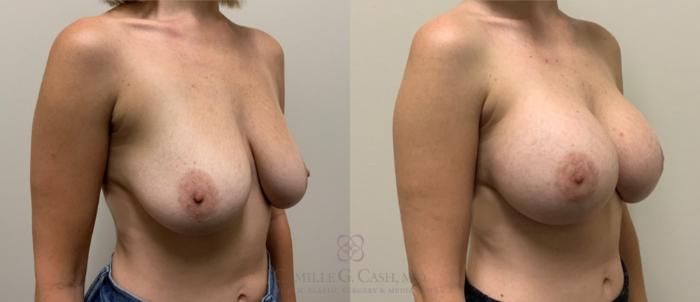 Before & After Breast Augmentation Case 460 Left Oblique View in Houston, TX