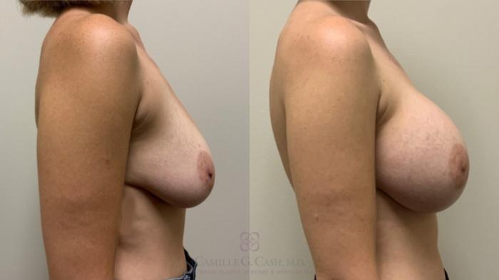 Before & After Breast Augmentation Case 460 Left Side View in Houston, TX