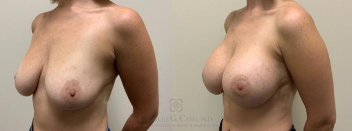 Before & After Breast Augmentation Case 460 Right Oblique View in Houston, TX