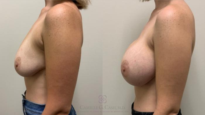Before & After Breast Augmentation Case 460 Right Side View in Houston, TX