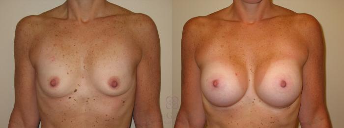Before & After Breast Augmentation Case 47 View #1 View in Houston, TX