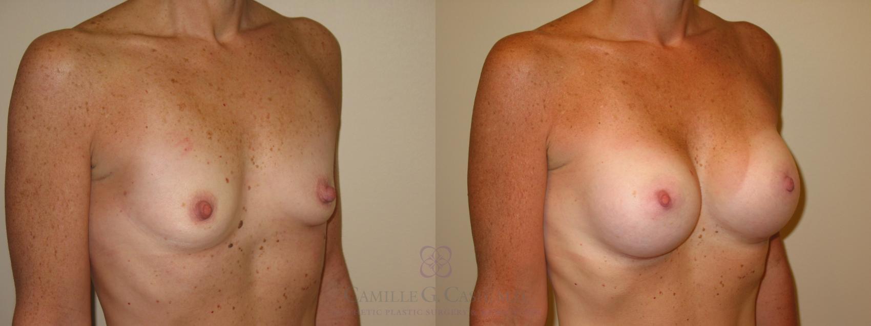 Before & After Breast Augmentation Case 47 View #2 View in Houston, TX