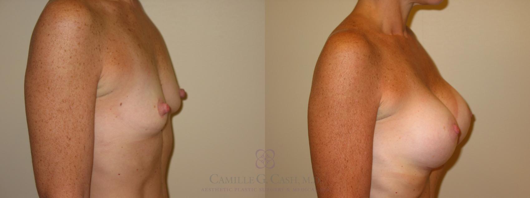 Before & After Breast Augmentation Case 47 View #3 View in Houston, TX