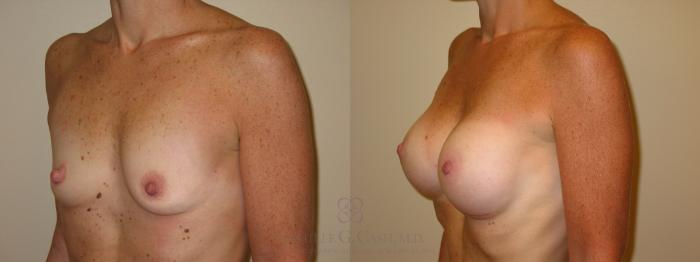 Before & After Breast Augmentation Case 47 View #4 View in Houston, TX