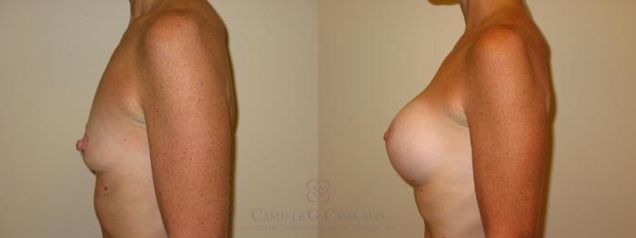 Before & After Breast Augmentation Case 47 View #5 View in Houston, TX