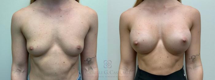 Before & After Breast Augmentation Case 479 Front View in Houston, TX