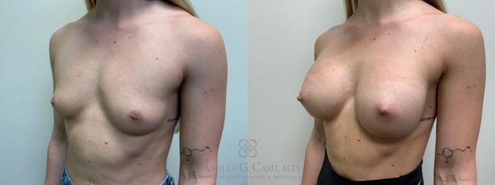 Before & After Breast Augmentation Case 479 Left Oblique View in Houston, TX